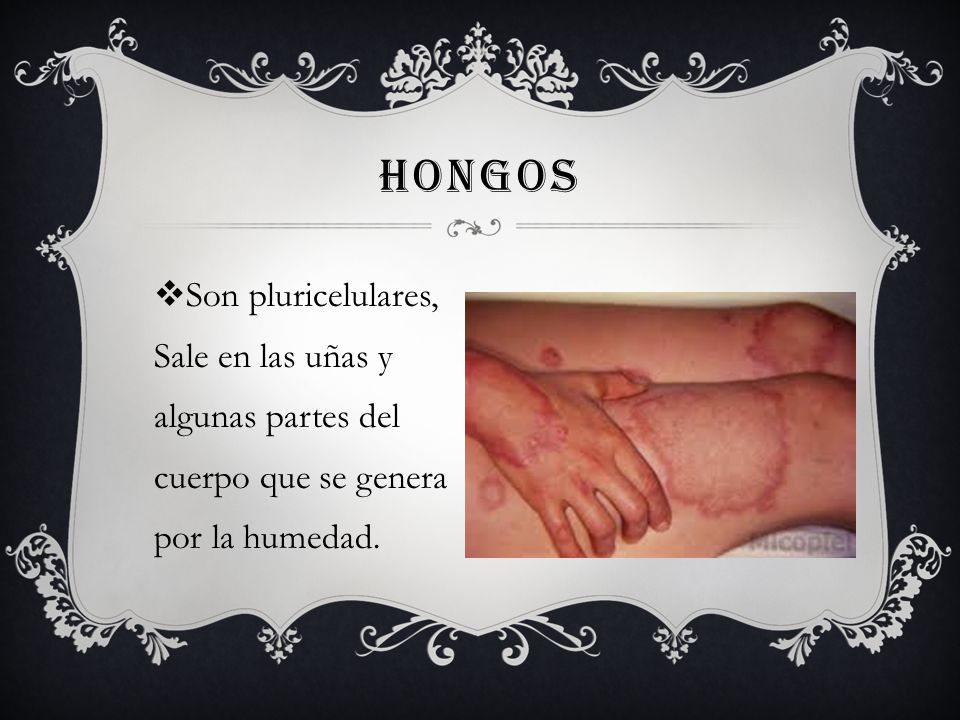 hongos Son pluricelulares, Sale en las uñas y algunas partes del cuerpo que se genera por la humedad.