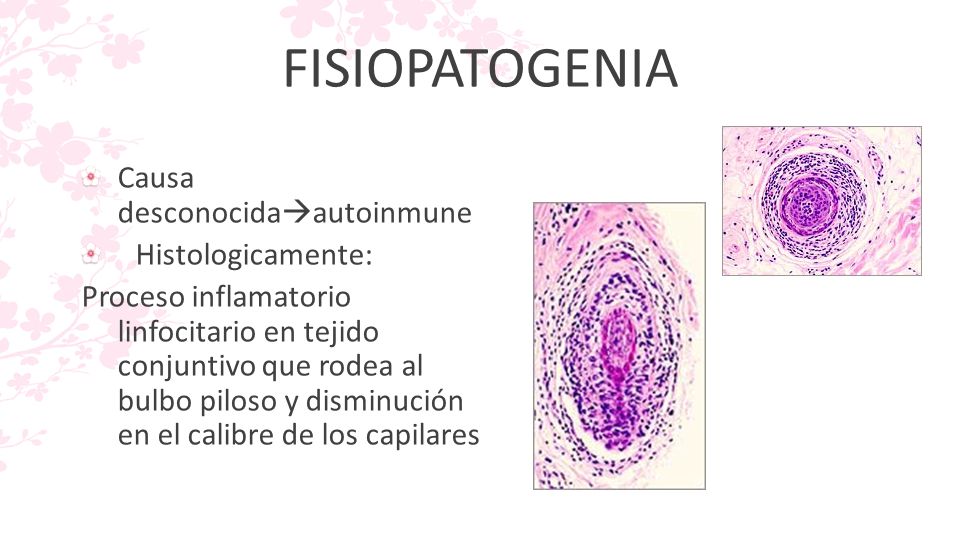 FISIOPATOGENIA Causa desconocidaautoinmune Histologicamente: