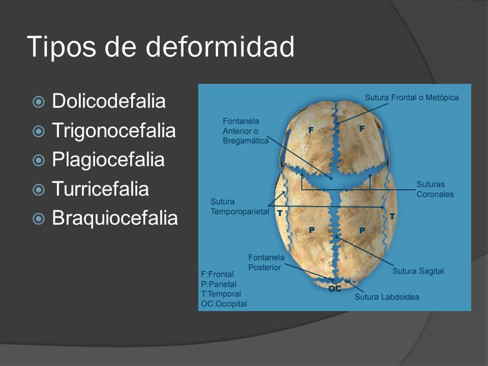 Tipos de deformidad Dolicodefalia Trigonocefalia Plagiocefalia