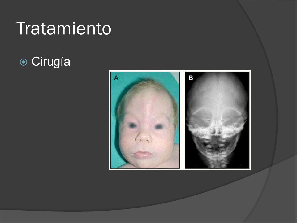 Tratamiento Cirugía