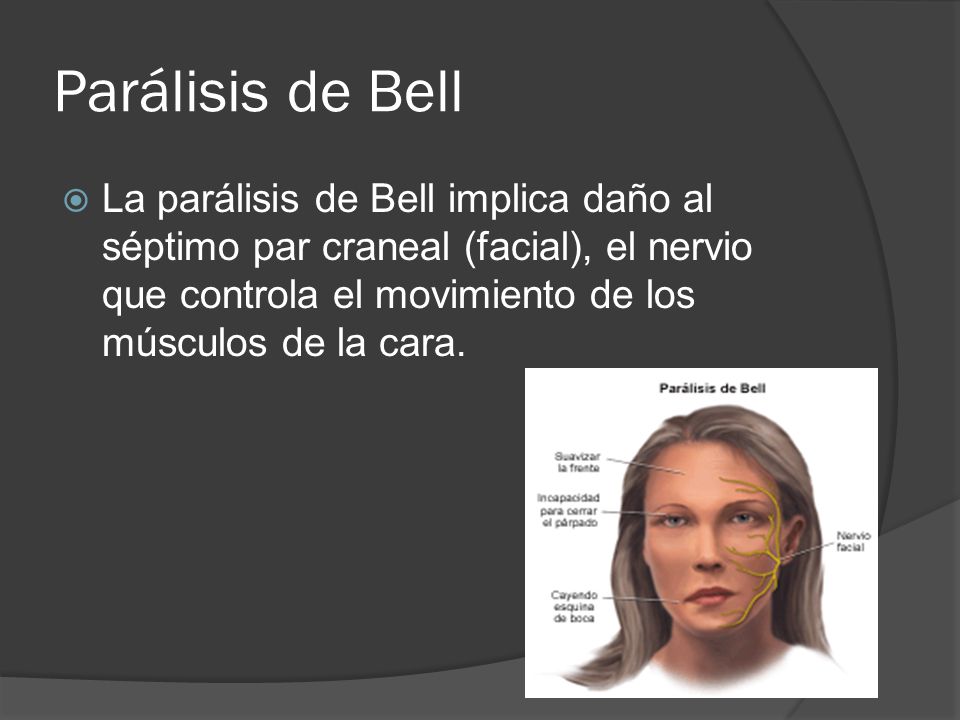Parálisis de Bell La parálisis de Bell implica daño al séptimo par craneal (facial), el nervio que controla el movimiento de los músculos de la cara.