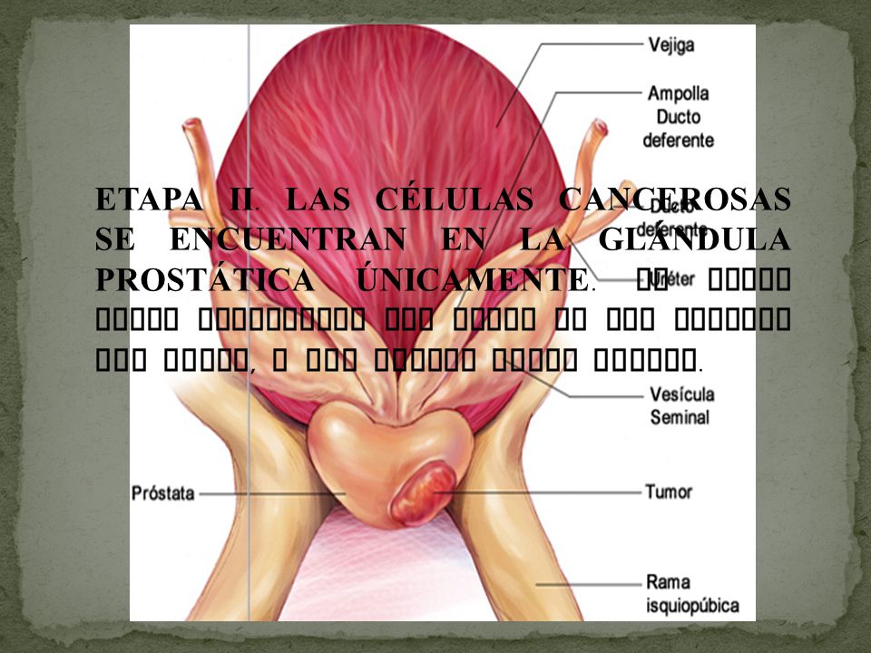 ETAPA II. LAS CÉLULAS CANCEROSAS SE ENCUENTRAN EN LA GLÁNDULA PROSTÁTICA ÚNICAMENTE.