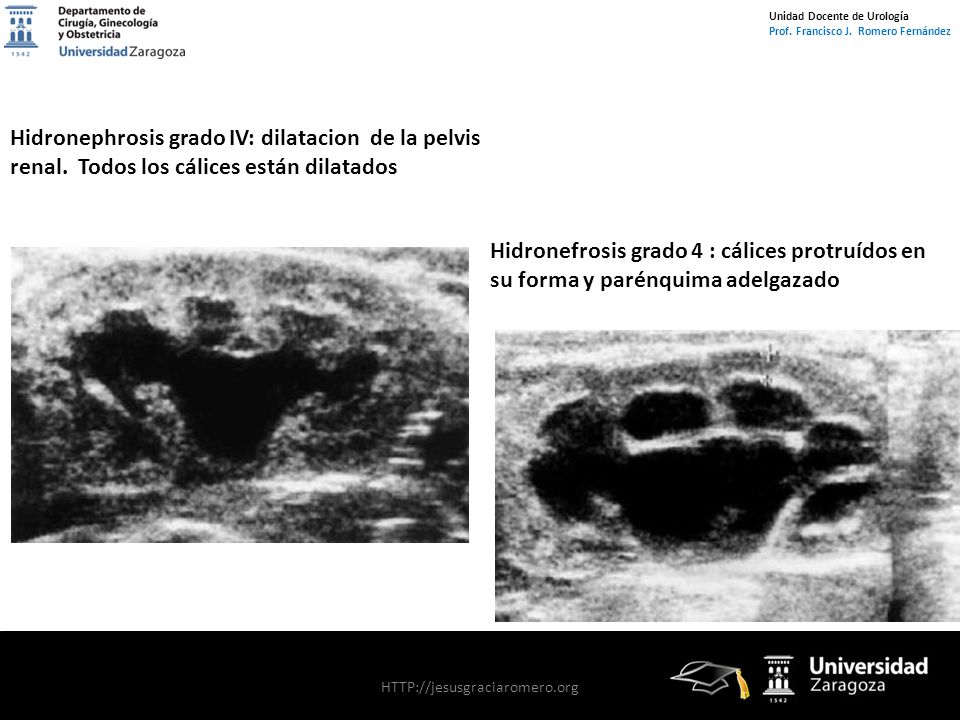Hidronephrosis grado IV: dilatacion de la pelvis renal. Todos los cálices están dilatados.