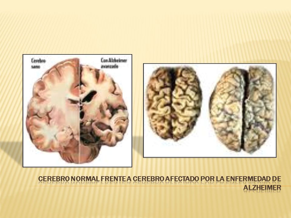 Cerebro normal frente a cerebro afectado por la Enfermedad de Alzheimer