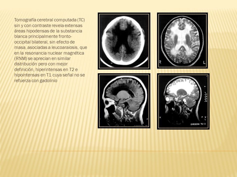 Tomografía cerebral computada (TC) sin y con contraste revela extensas áreas hipodensas de la substancia blanca principalmente fronto-occipital bilateral, sin efecto de masa, asociadas a leucoaraiosis, que en la resonancia nuclear magnética (RNM) se aprecian en similar distribución pero con mejor definición, hiperintensas en T2 e hipointensas en T1 cuya señal no se refuerza con gadolinio