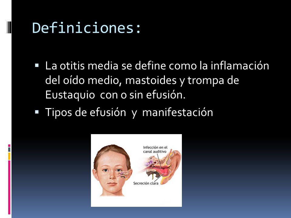 Definiciones: La otitis media se define como la inflamación del oído medio, mastoides y trompa de Eustaquio con o sin efusión.