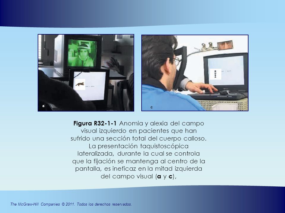 Figura R Anomia y alexia del campo visual izquierdo en pacientes que han sufrido una sección total del cuerpo calloso.