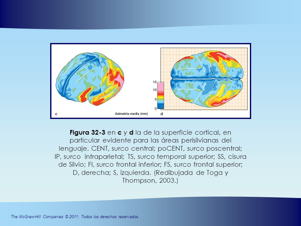 Figura 32-3 en c y d la de la superficie cortical, en particular evidente para las áreas perisilvianas del lenguaje.