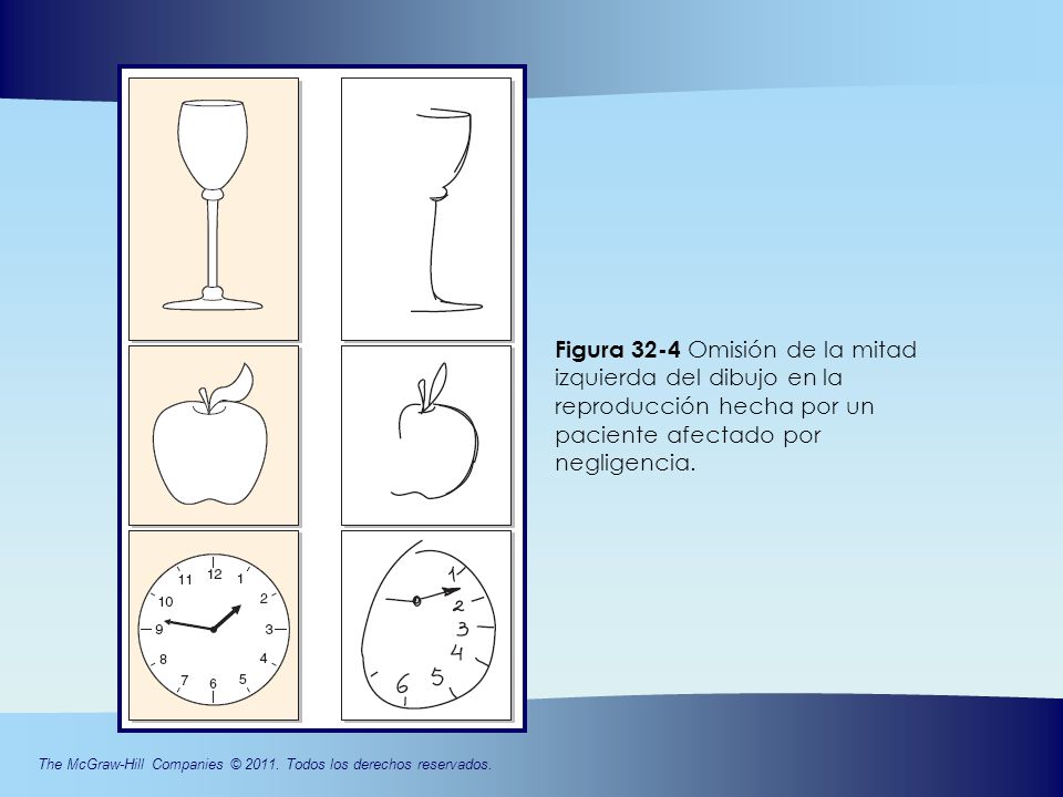 Figura 32-4 Omisión de la mitad izquierda del dibujo en la reproducción hecha por un paciente afectado por negligencia.