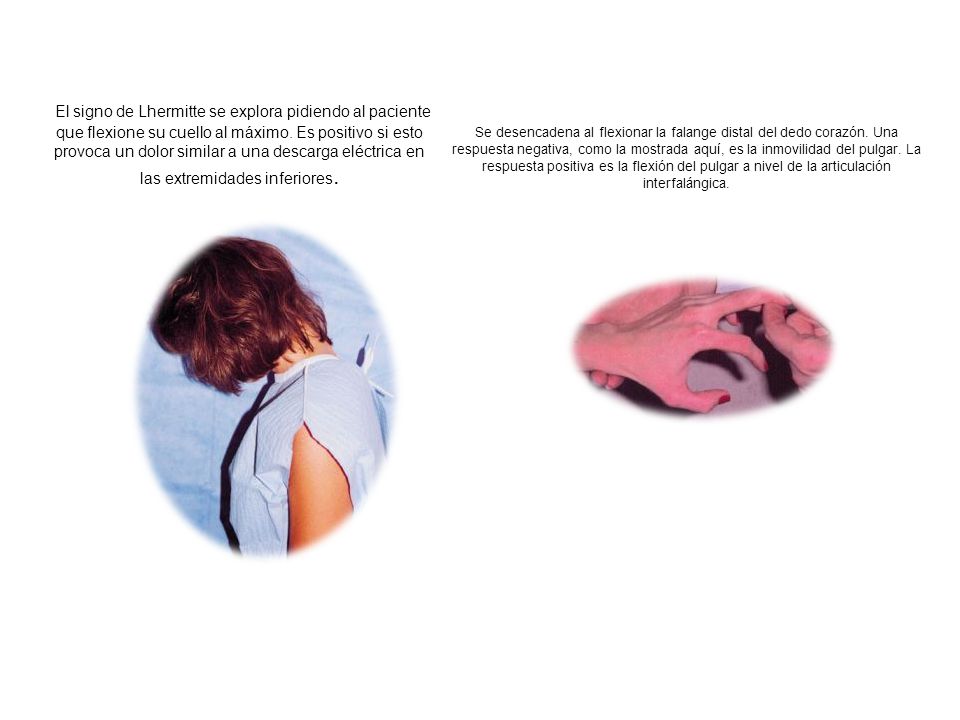 El signo de Lhermitte se explora pidiendo al paciente que flexione su cuello al máximo. Es positivo si esto provoca un dolor similar a una descarga eléctrica en las extremidades inferiores.
