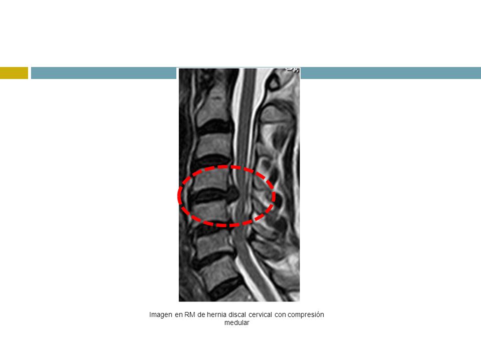 Imagen en RM de hernia discal cervical con compresión medular