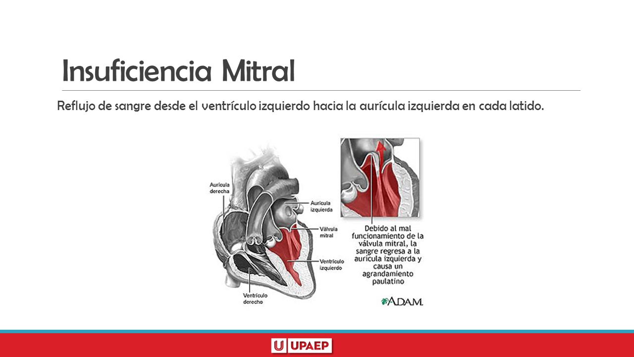Insuficiencia Mitral Reflujo de sangre desde el ventrículo izquierdo hacia la aurícula izquierda en cada latido.