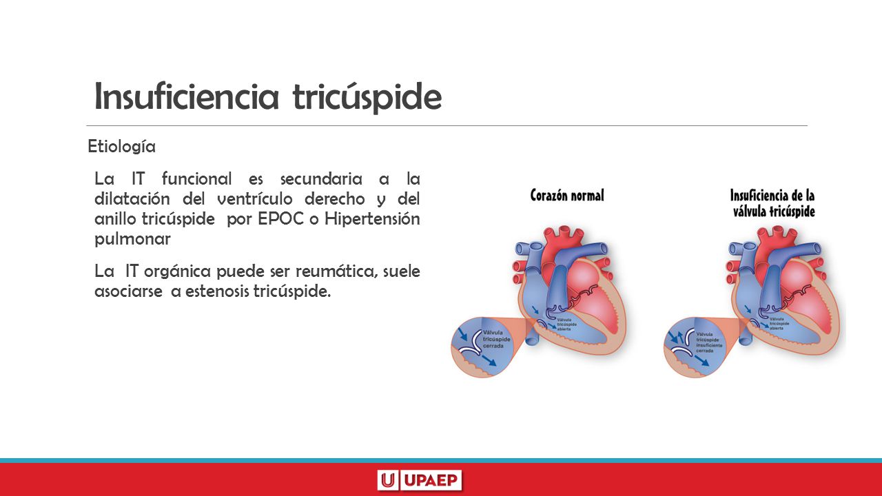 Insuficiencia tricúspide