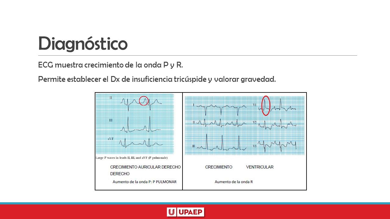 Diagnóstico ECG muestra crecimiento de la onda P y R.