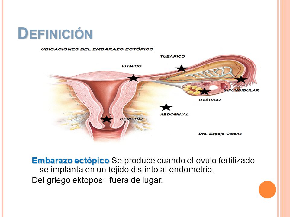 Definición Embarazo ectópico Se produce cuando el ovulo fertilizado se implanta en un tejido distinto al endometrio.