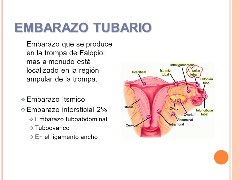 EMBARAZO TUBARIO Embarazo que se produce en la trompa de Falopio: mas a menudo está localizado en la región ampular de la trompa.