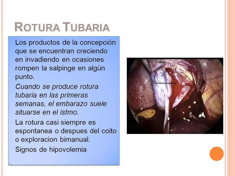 Rotura Tubaria Los productos de la concepción que se encuentran creciendo en invadiendo en ocasiones rompen la salpinge en algún punto.