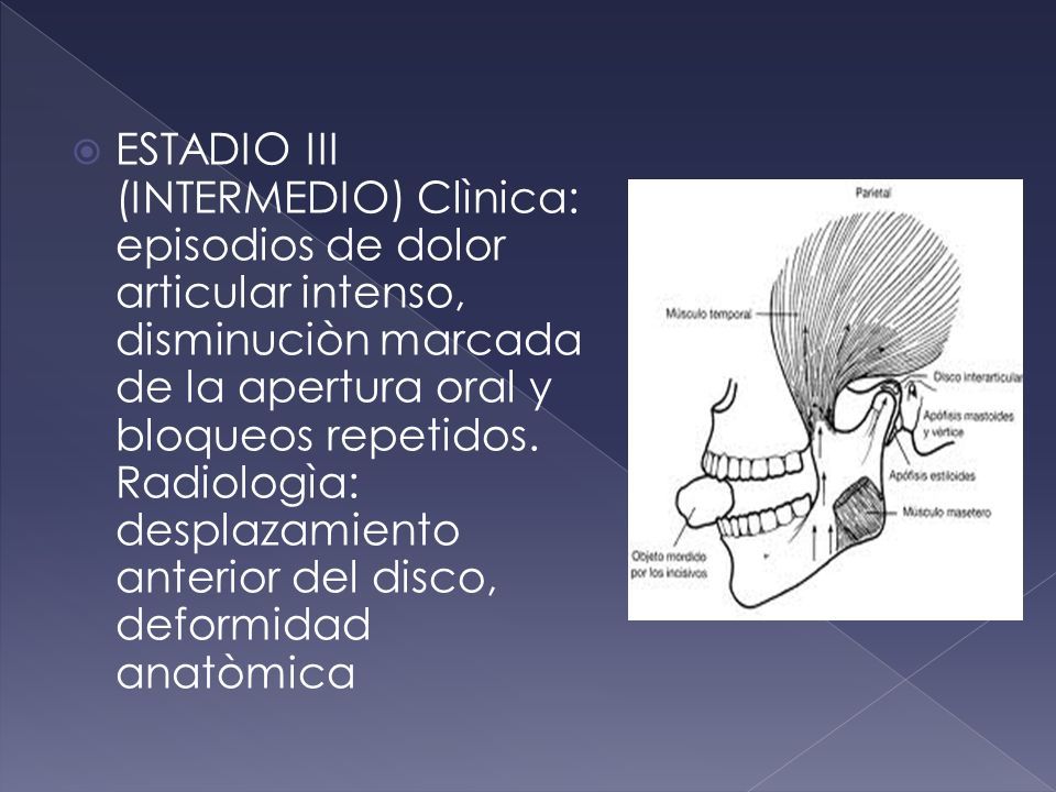 ESTADIO III (INTERMEDIO) Clìnica: episodios de dolor articular intenso, disminuciòn marcada de la apertura oral y bloqueos repetidos.
