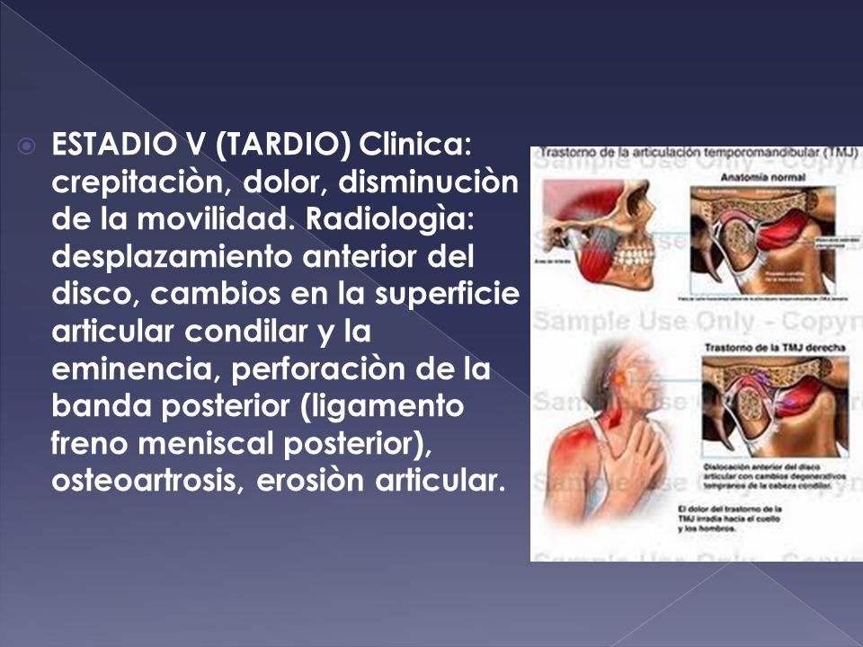 ESTADIO V (TARDIO) Clinica: crepitaciòn, dolor, disminuciòn de la movilidad.