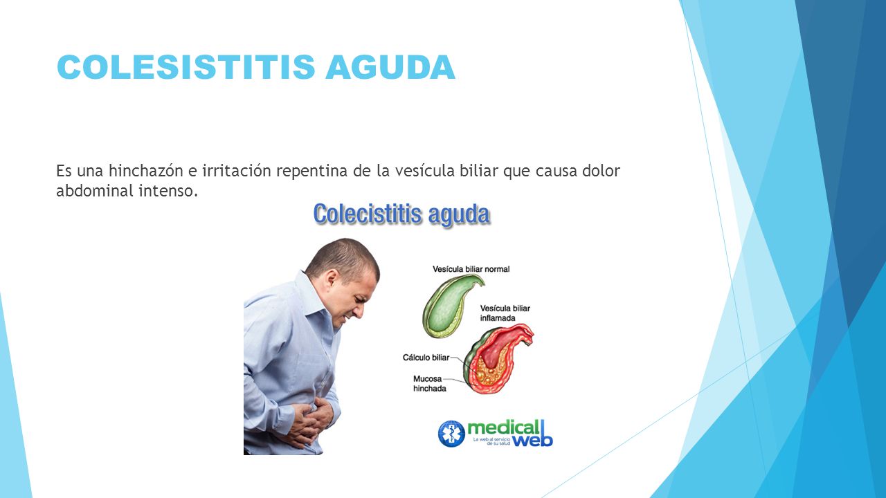 COLESISTITIS AGUDA Es una hinchazón e irritación repentina de la vesícula biliar que causa dolor abdominal intenso.