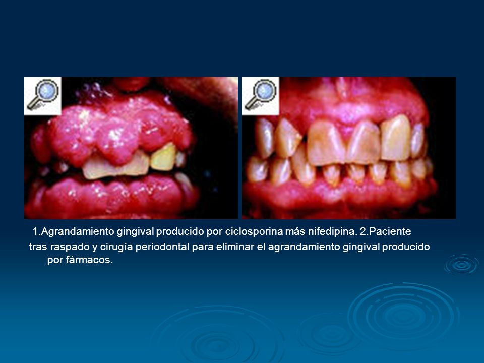 1. Agrandamiento gingival producido por ciclosporina más nifedipina. 2