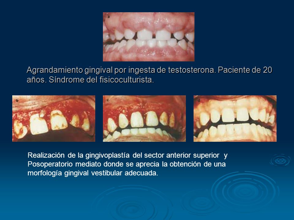 Agrandamiento gingival por ingesta de testosterona. Paciente de 20 años. Síndrome del fisicoculturista.