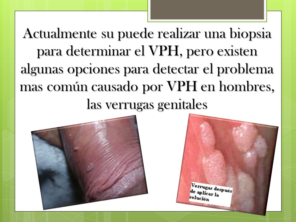Actualmente su puede realizar una biopsia para determinar el VPH, pero existen algunas opciones para detectar el problema mas común causado por VPH en hombres, las verrugas genitales