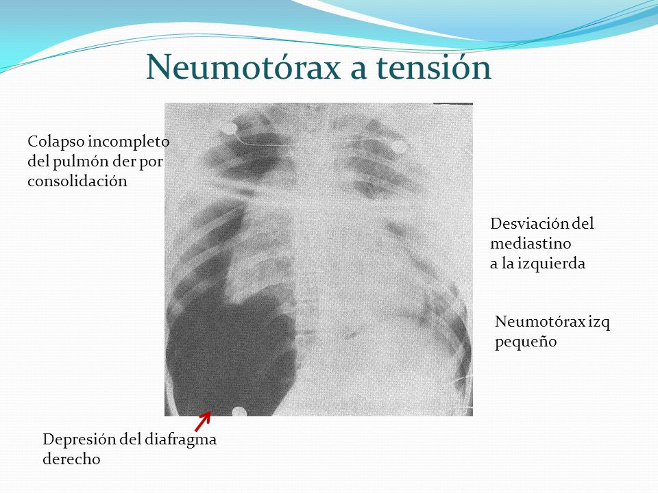 Neumotórax a tensión Colapso incompleto del pulmón der por