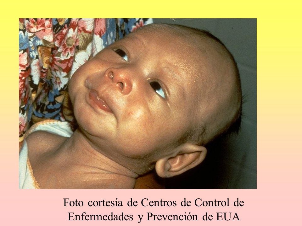 Foto cortesía de Centros de Control de Enfermedades y Prevención de EUA