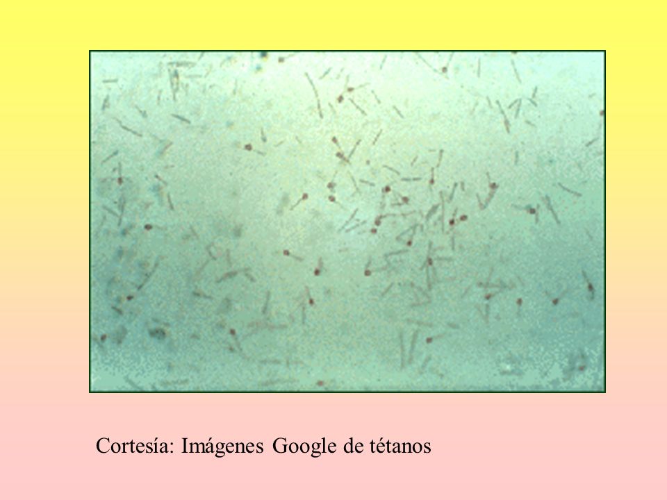 Cortesía: Imágenes Google de tétanos