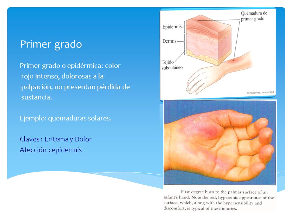 Primer grado Primer grado o epidérmica: color