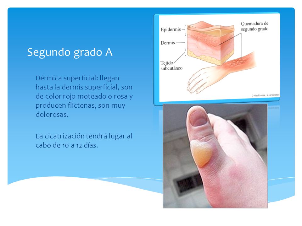 Segundo grado A Dérmica superficial: llegan hasta la dermis superficial, son de color rojo moteado o rosa y producen flictenas, son muy dolorosas.