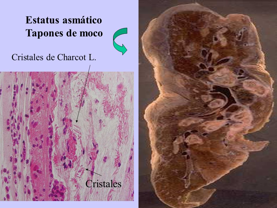 Estatus asmático Tapones de moco Cristales Cristales de Charcot L.