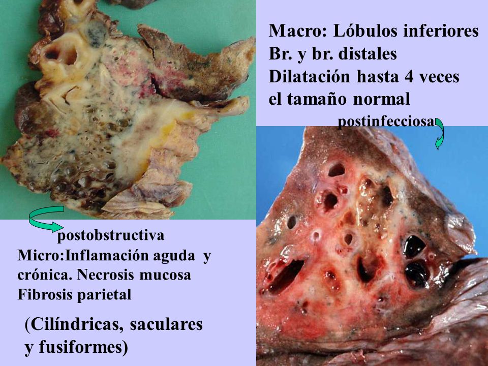 Macro: Lóbulos inferiores Br. y br. distales Dilatación hasta 4 veces