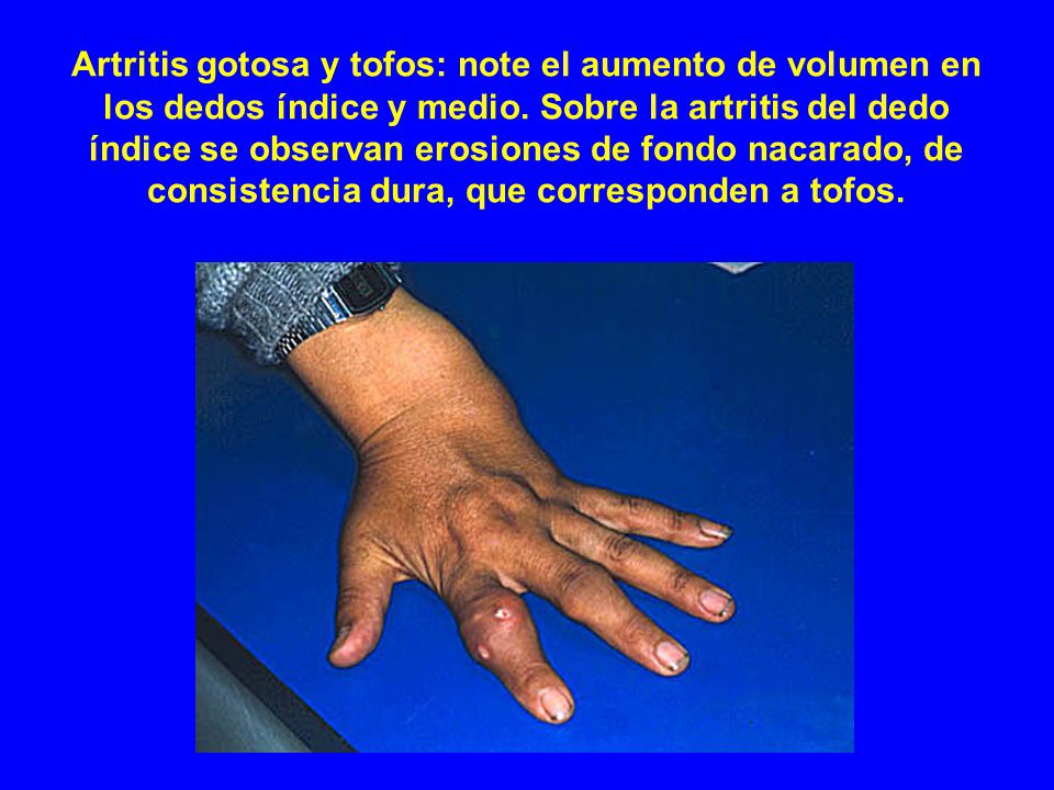 Artritis gotosa y tofos: note el aumento de volumen en los dedos índice y medio.