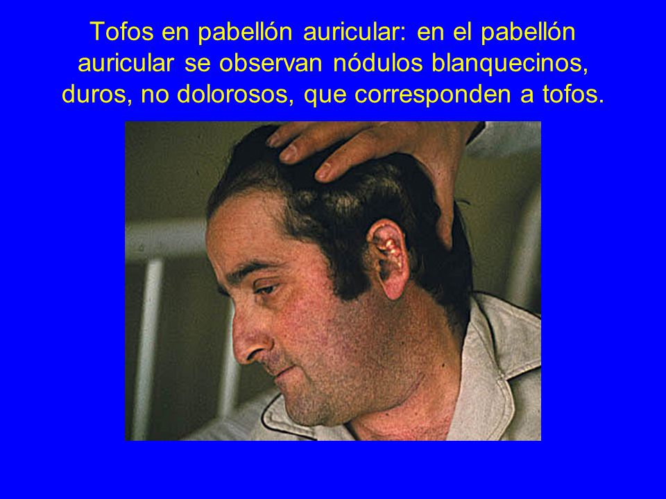 Tofos en pabellón auricular: en el pabellón auricular se observan nódulos blanquecinos, duros, no dolorosos, que corresponden a tofos.