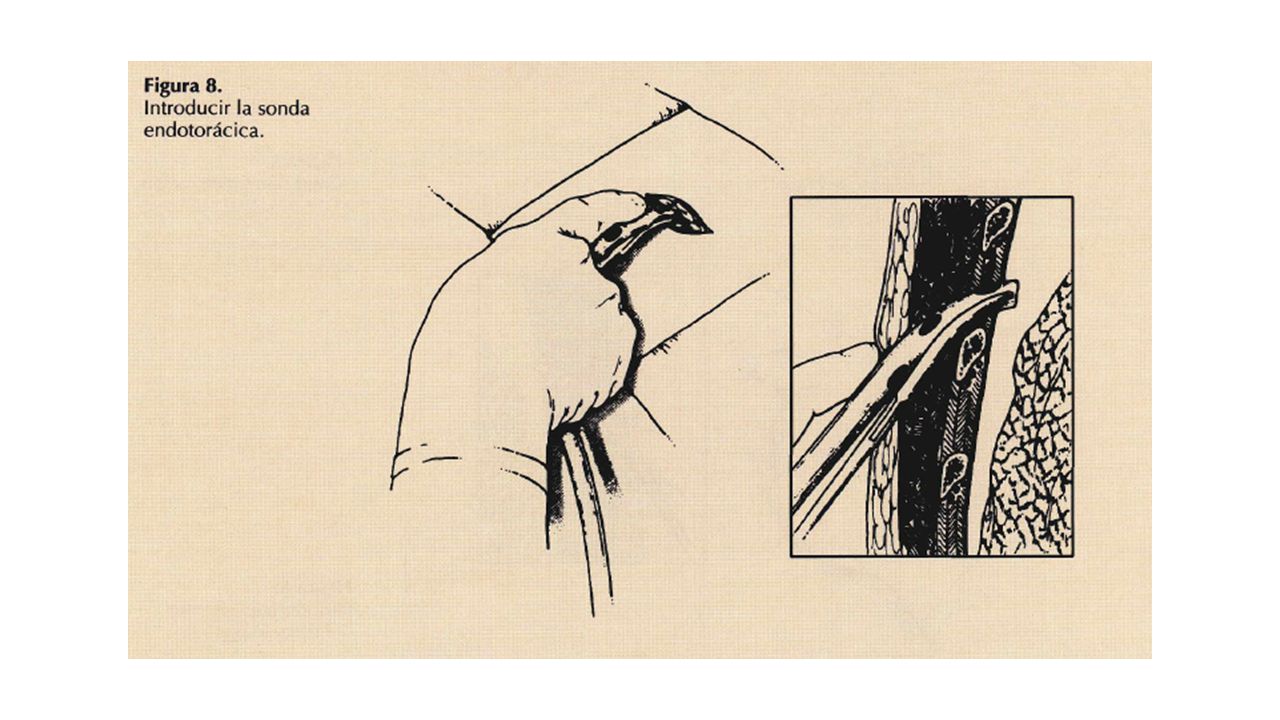 Colocación del tubo endotorácico: Clampar el tubo de tórax en su extremo tal con la pinza de Kocher e introducirlo en la cavidad pleura) en dirección apical, para drenar un neumotórax, o posterobasal, para drenar un derrame o un hemotórax.
