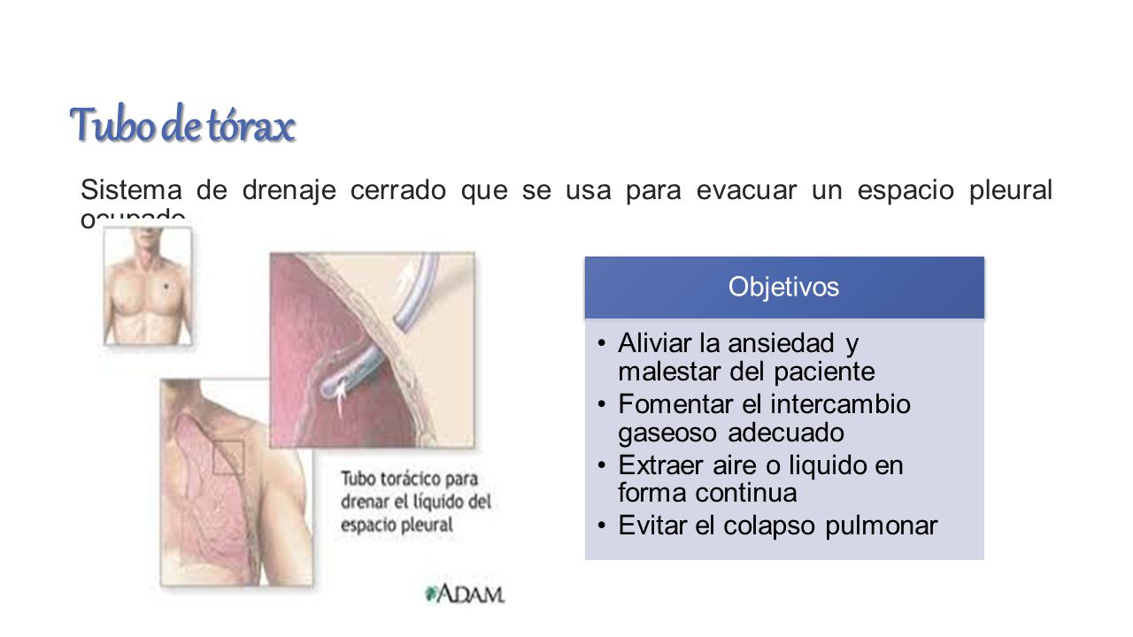 Tubo de tórax Sistema de drenaje cerrado que se usa para evacuar un espacio pleural ocupado. Objetivos.