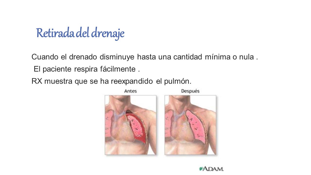 Retirada del drenaje Cuando el drenado disminuye hasta una cantidad mínima o nula . El paciente respira fácilmente .