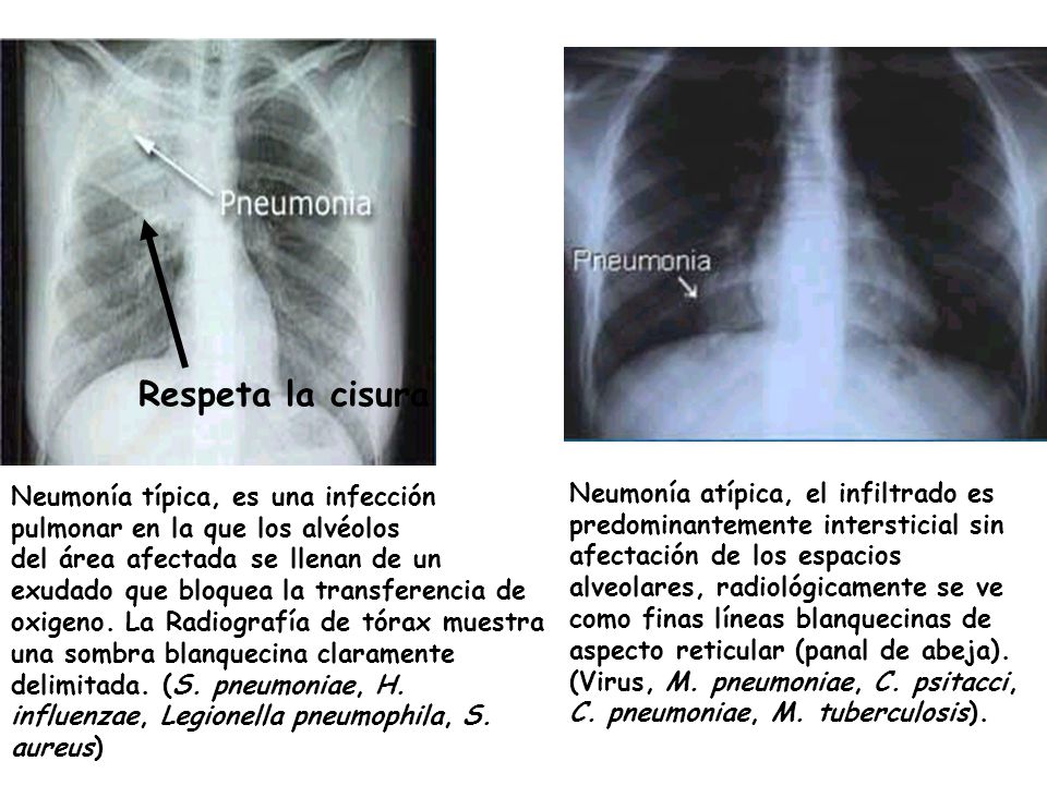 Respeta la cisura Neumonía típica, es una infección pulmonar en la que los alvéolos.