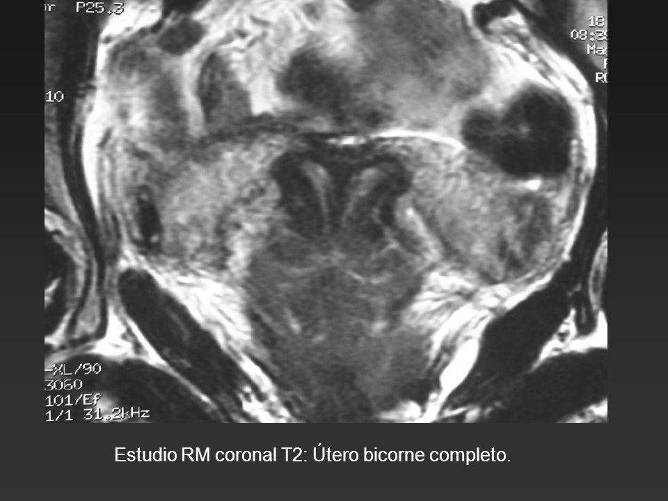 Estudio RM coronal T2: Útero bicorne completo.