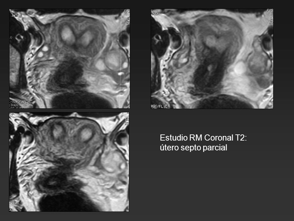 Estudio RM Coronal T2: útero septo parcial