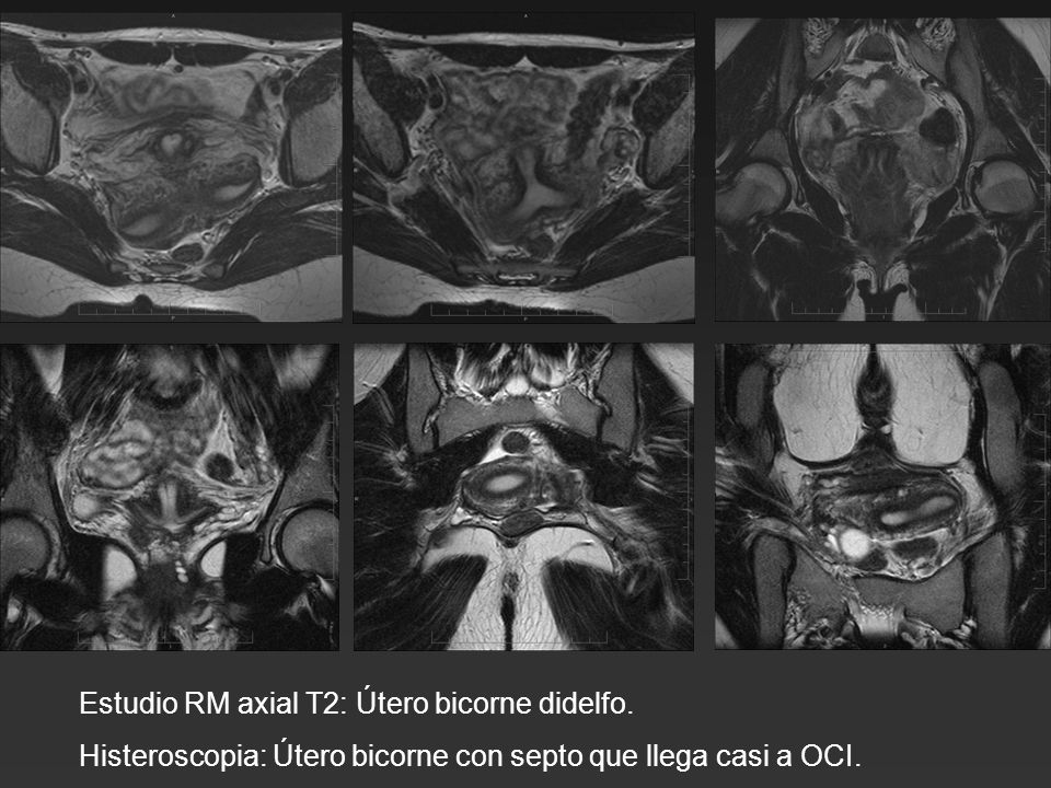 Estudio RM axial T2: Útero bicorne didelfo.