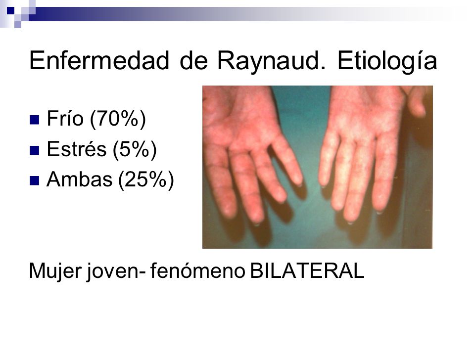 Enfermedad de Raynaud. Etiología