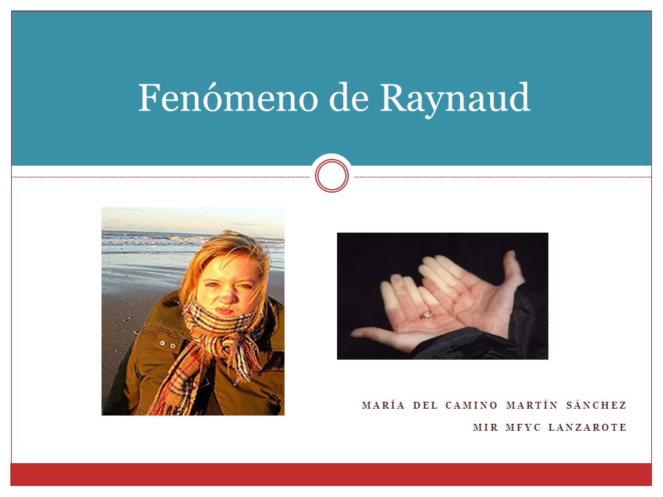Fenómeno de Raynaud María del camino martín sÁnchez mir MFyC Lanzarote