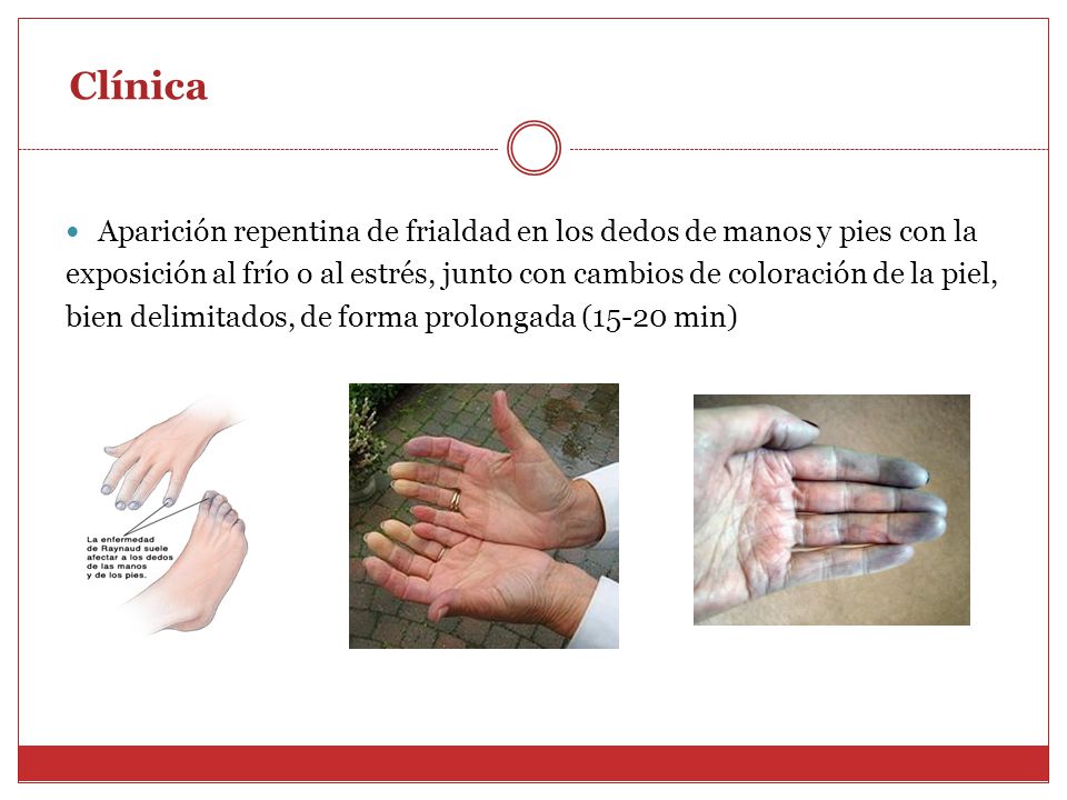 Clínica Aparición repentina de frialdad en los dedos de manos y pies con la.