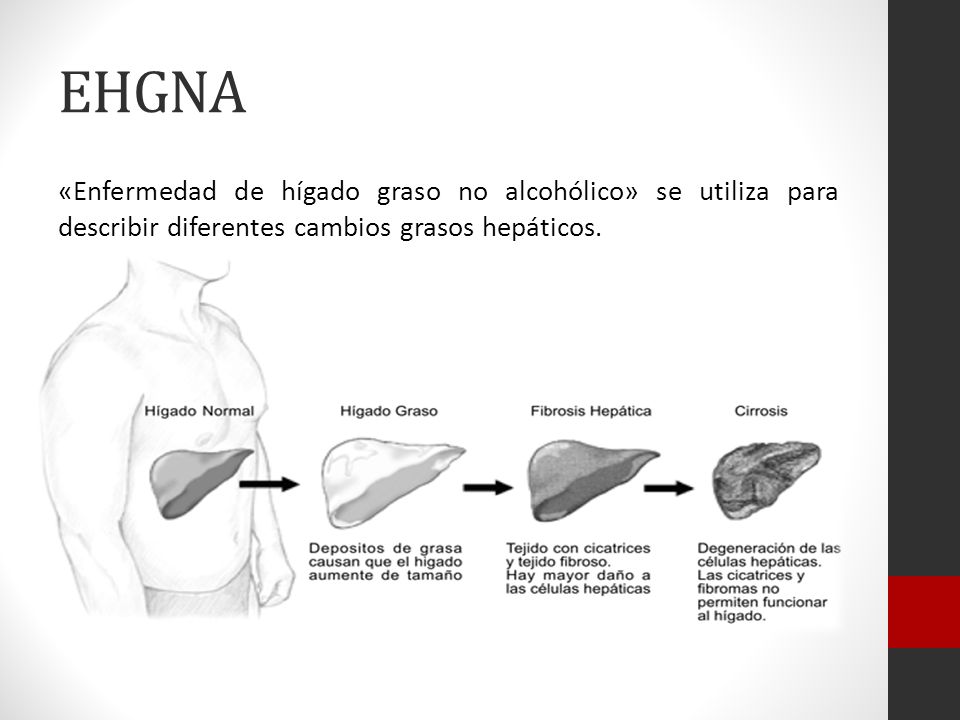 EHGNA «Enfermedad de hígado graso no alcohólico» se utiliza para describir diferentes cambios grasos hepáticos.