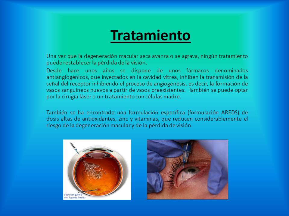 Tratamiento Una vez que la degeneración macular seca avanza o se agrava, ningún tratamiento puede restablecer la pérdida de la visión.