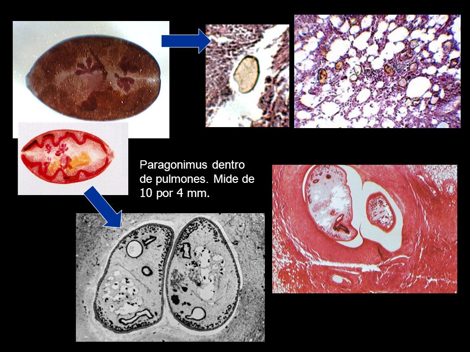 Paragonimus dentro de pulmones. Mide de 10 por 4 mm.