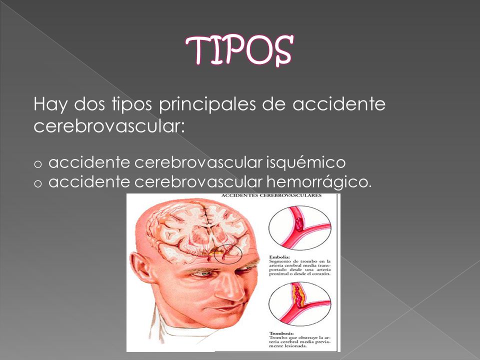 TIPOS Hay dos tipos principales de accidente cerebrovascular: